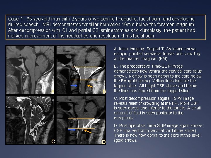 Case 1: 35 year-old man with 2 years of worsening headache, facial pain, and