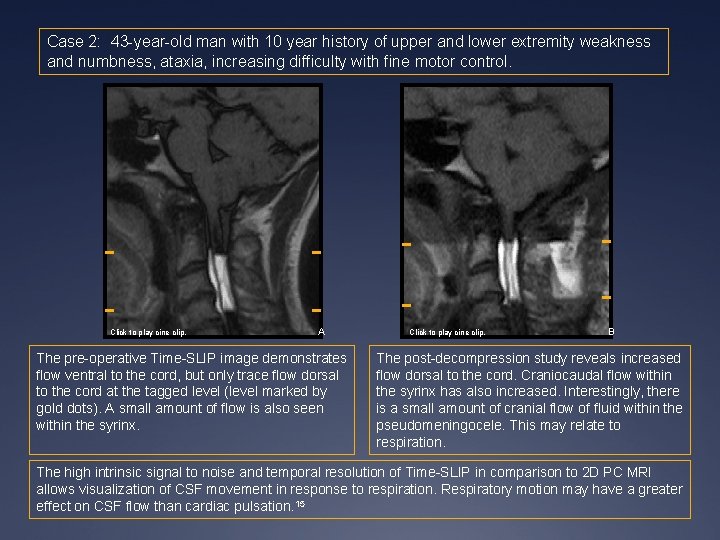Case 2: 43 -year-old man with 10 year history of upper and lower extremity Case 2: 43 -year-old man with 10 year history of upper and lower extremity
