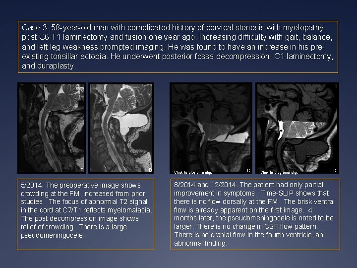Case 3: 58 -year-old man with complicated history of cervical stenosis with myelopathy post Case 3: 58 -year-old man with complicated history of cervical stenosis with myelopathy post