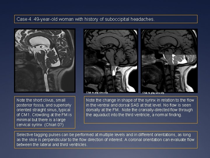 Case 4. 49 -year-old woman with history of suboccipital headaches. Click to play cine Case 4. 49 -year-old woman with history of suboccipital headaches. Click to play cine