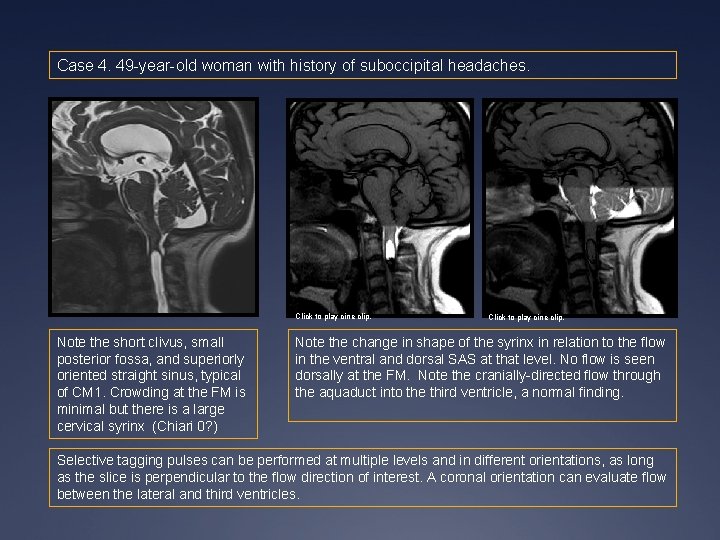 Case 4. 49 -year-old woman with history of suboccipital headaches. Click to play cine