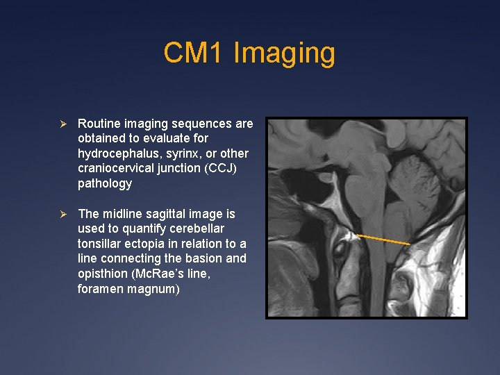 CM 1 Imaging Ø Routine imaging sequences are obtained to evaluate for hydrocephalus, syrinx,