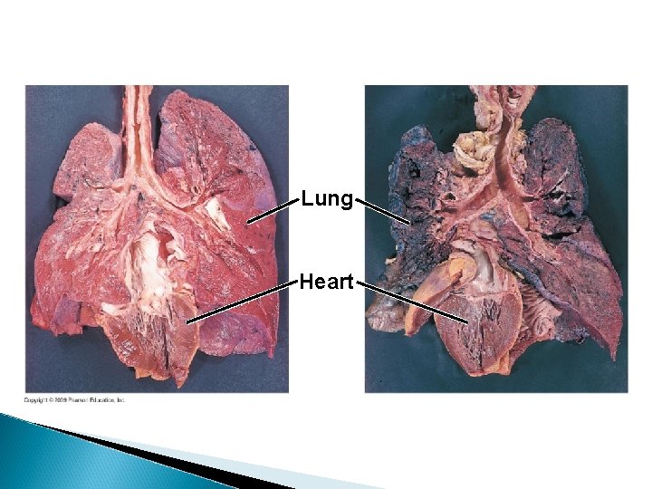 Lung Heart 