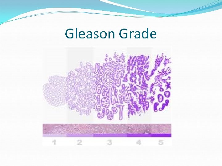 Gleason Grade 