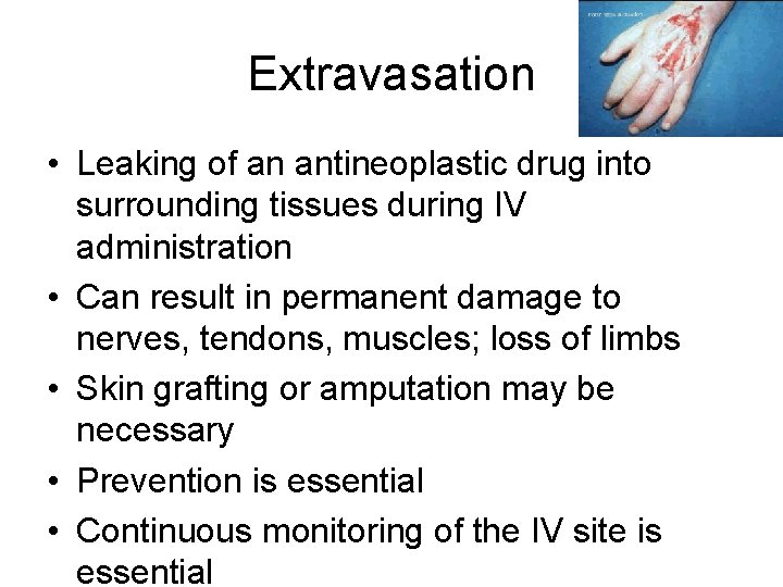 Extravasation • Leaking of an antineoplastic drug into surrounding tissues during IV administration •