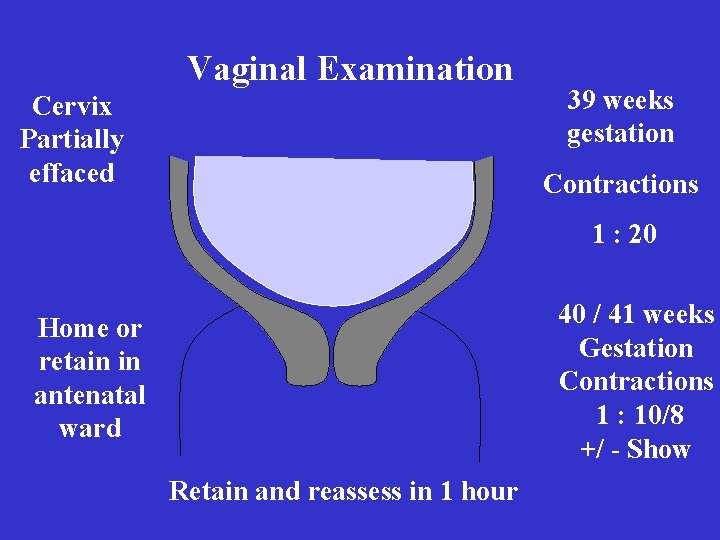 Vaginal Examination Cervix Partially effaced 39 weeks gestation Contractions 1 : 20 40 /