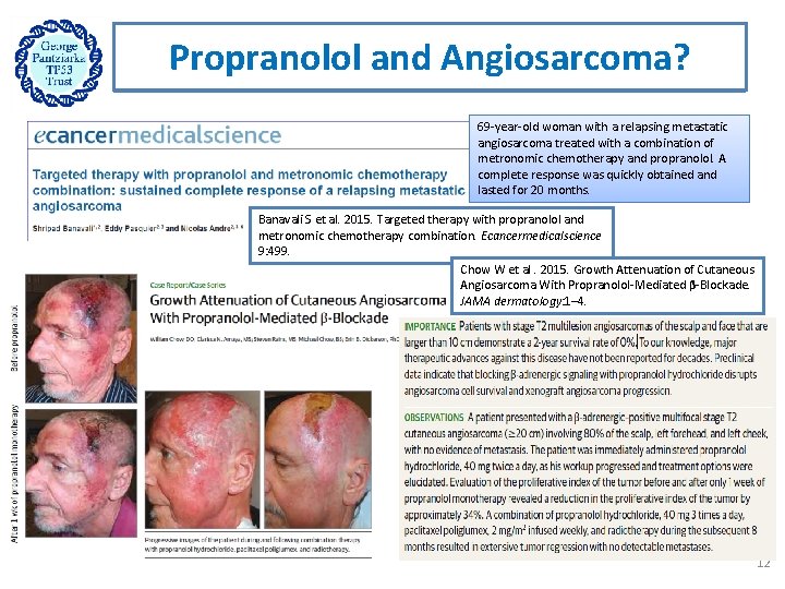 Propranolol and Angiosarcoma? 69 year old woman with a relapsing metastatic angiosarcoma treated with