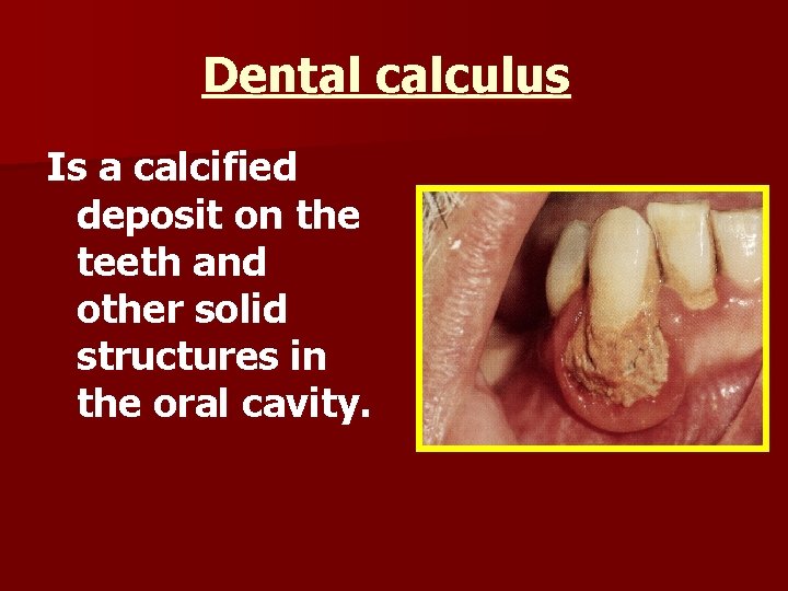Dental calculus Is a calcified deposit on the teeth and other solid structures in
