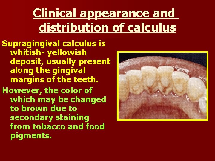 Clinical appearance and distribution of calculus Supragingival calculus is whitish- yellowish deposit, usually present