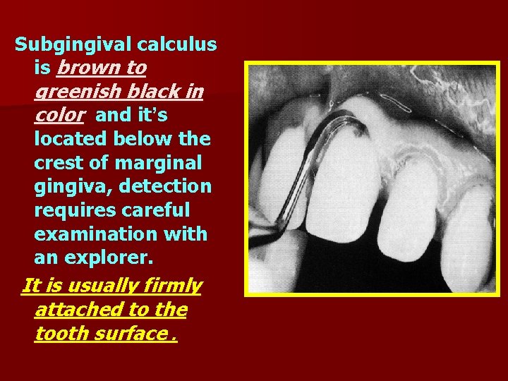 Subgingival calculus is brown to greenish black in color and it’s located below the