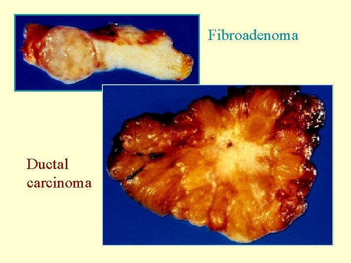 Fibroadenoma Ductal carcinoma 