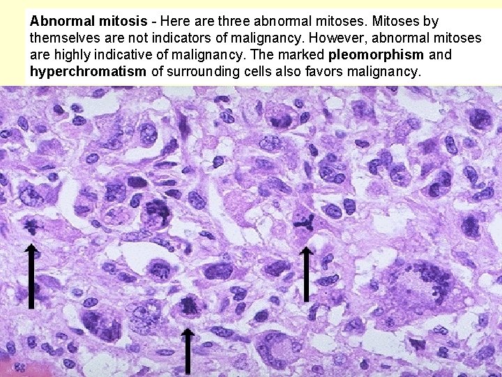 Abnormal mitosis - Here are three abnormal mitoses. Mitoses by themselves are not indicators