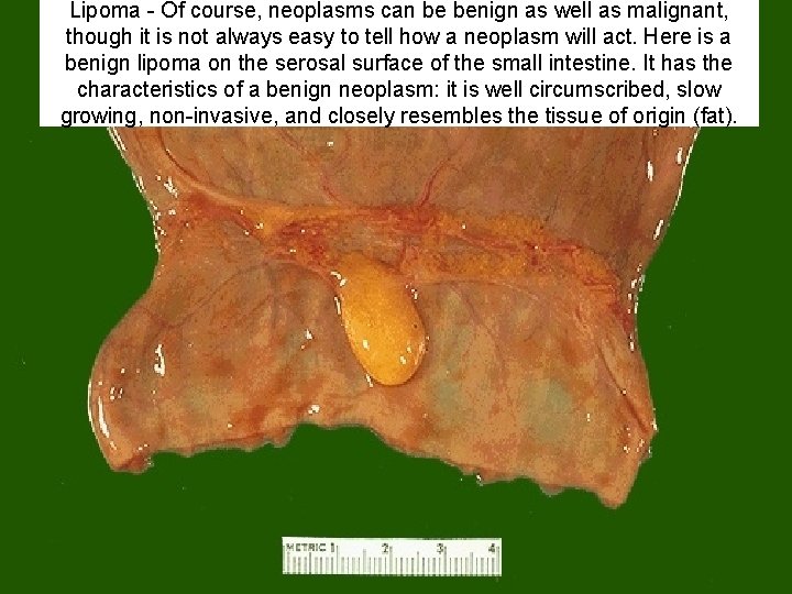 Lipoma - Of course, neoplasms can be benign as well as malignant, though it