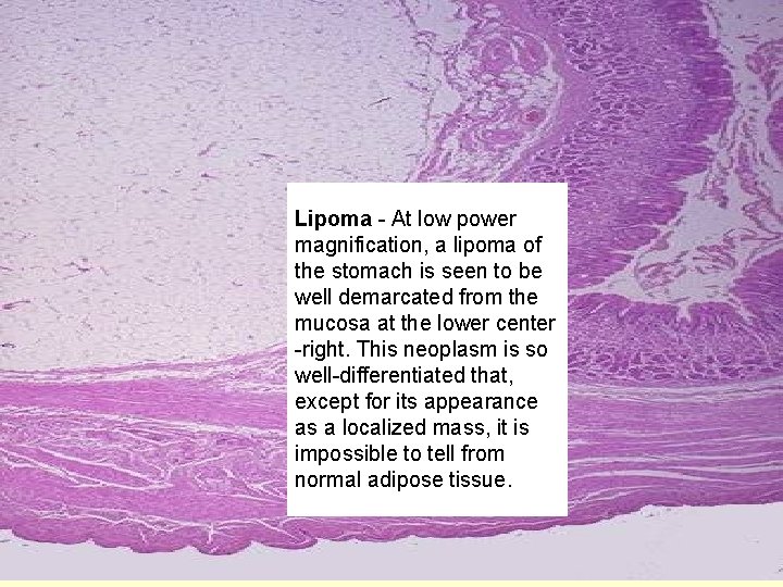 Lipoma - At low power magnification, a lipoma of the stomach is seen to