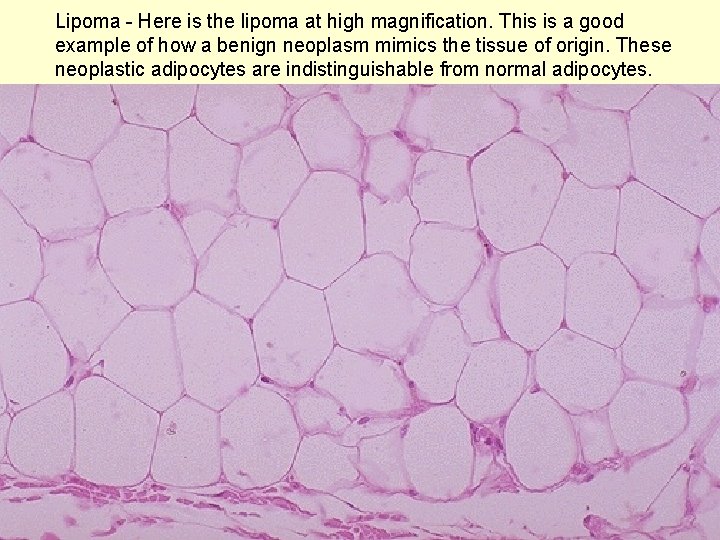 Lipoma - Here is the lipoma at high magnification. This is a good example