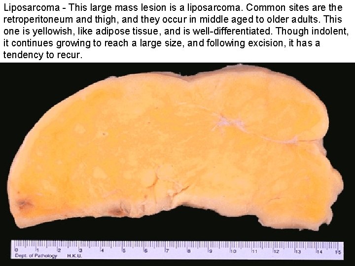 Liposarcoma - This large mass lesion is a liposarcoma. Common sites are the retroperitoneum