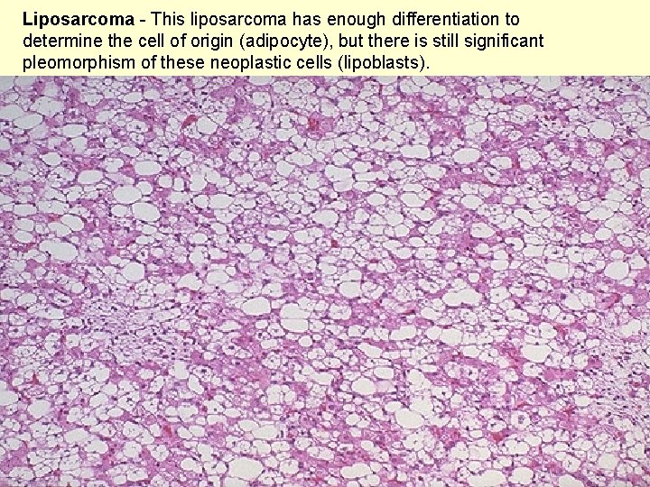 Liposarcoma - This liposarcoma has enough differentiation to determine the cell of origin (adipocyte),