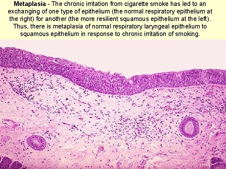 Metaplasia - The chronic irritation from cigarette smoke has led to an exchanging of