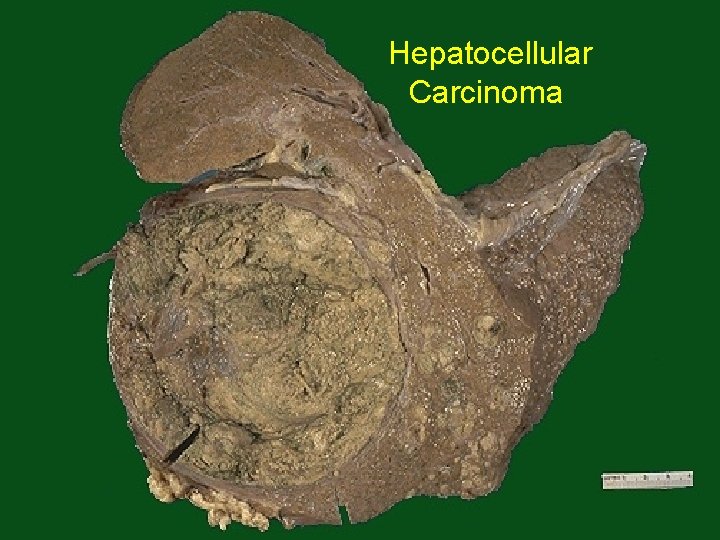 Hepatocellular Carcinoma 