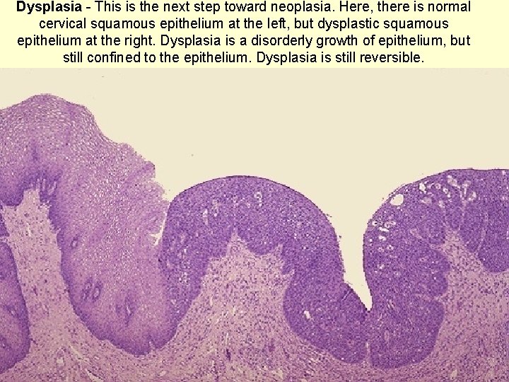 Dysplasia - This is the next step toward neoplasia. Here, there is normal cervical