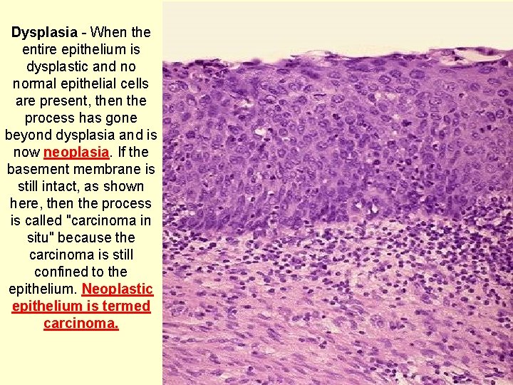 Dysplasia - When the entire epithelium is dysplastic and no normal epithelial cells are