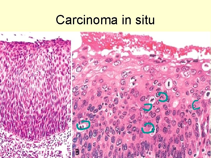 Carcinoma in situ 