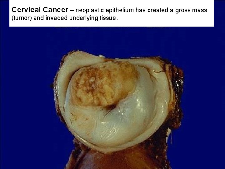 Cervical Cancer – neoplastic epithelium has created a gross mass (tumor) and invaded underlying