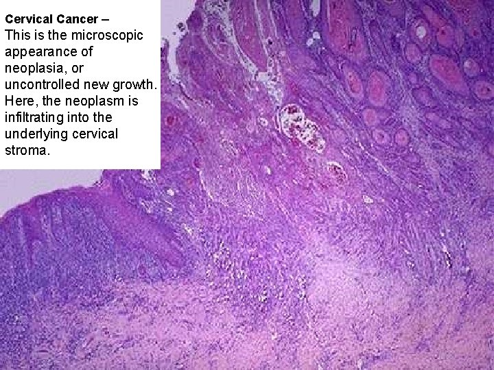 Cervical Cancer – This is the microscopic appearance of neoplasia, or uncontrolled new growth.