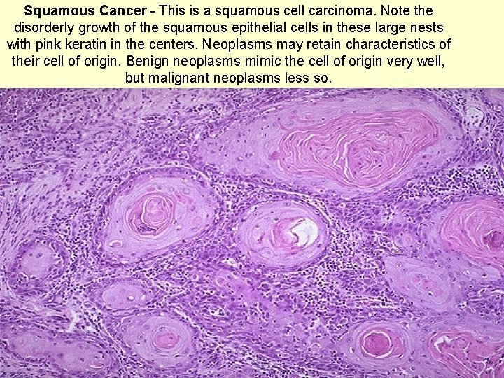 Squamous Cancer - This is a squamous cell carcinoma. Note the disorderly growth of