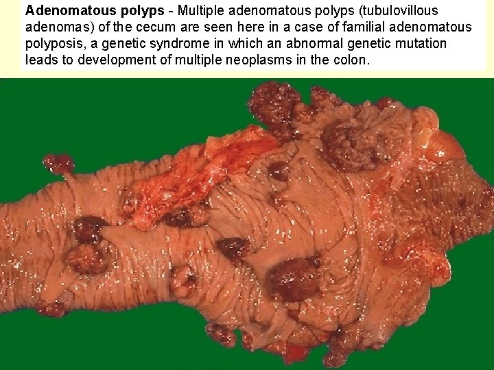 Adenomatous polyps - Multiple adenomatous polyps (tubulovillous adenomas) of the cecum are seen here