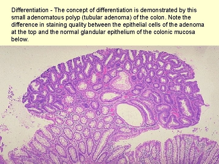 Differentiation - The concept of differentiation is demonstrated by this small adenomatous polyp (tubular