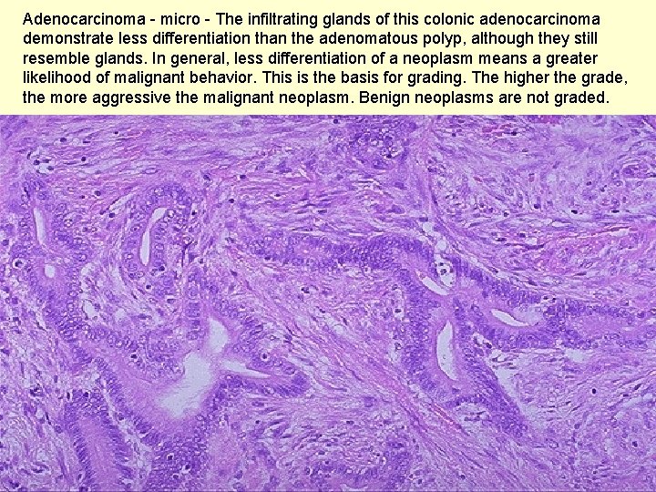 Adenocarcinoma - micro - The infiltrating glands of this colonic adenocarcinoma demonstrate less differentiation