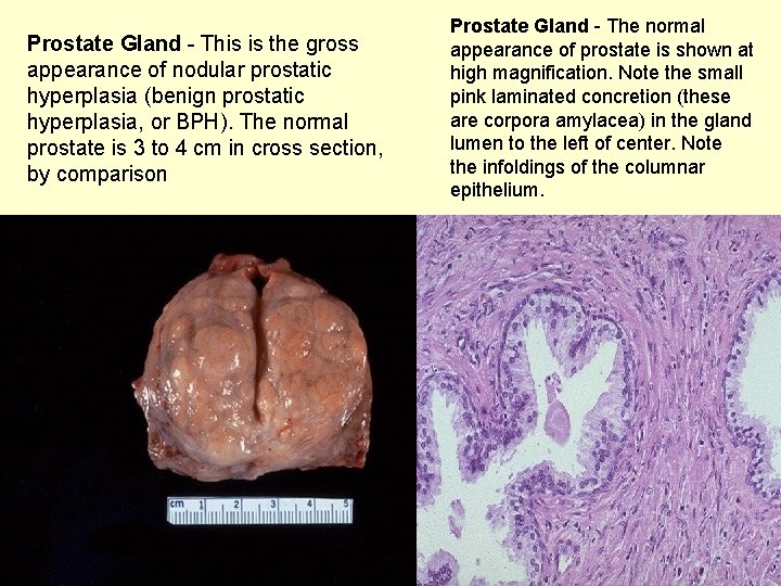 Prostate Gland - This is the gross appearance of nodular prostatic hyperplasia (benign prostatic