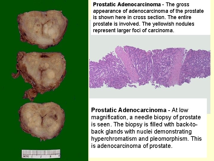 Prostatic Adenocarcinoma - The gross appearance of adenocarcinoma of the prostate is shown here