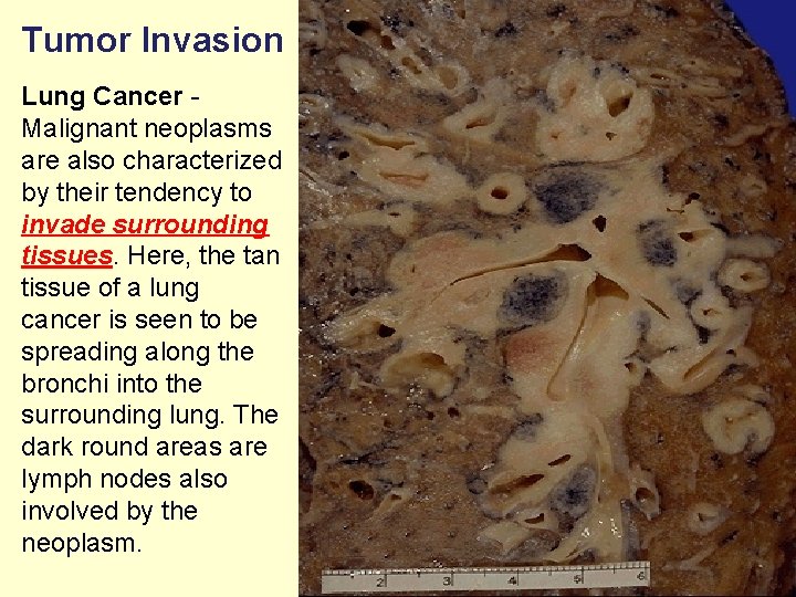 Tumor Invasion Lung Cancer Malignant neoplasms are also characterized by their tendency to invade