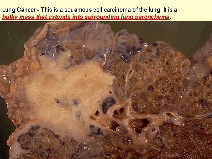 Lung Cancer - This is a squamous cell carcinoma of the lung. It is