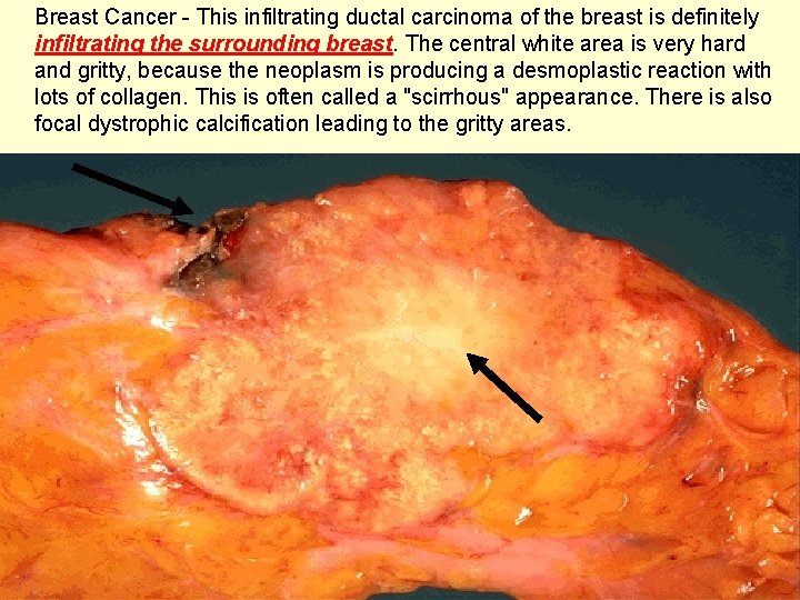 Breast Cancer - This infiltrating ductal carcinoma of the breast is definitely infiltrating the