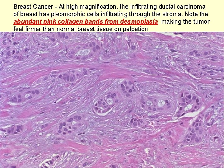 Breast Cancer - At high magnification, the infiltrating ductal carcinoma of breast has pleomorphic