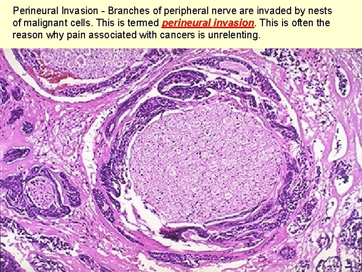 Perineural Invasion - Branches of peripheral nerve are invaded by nests of malignant cells.