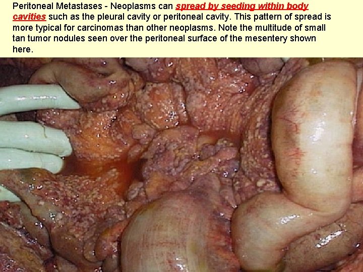 Peritoneal Metastases - Neoplasms can spread by seeding within body cavities such as the