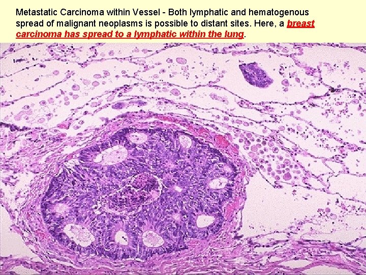 Metastatic Carcinoma within Vessel - Both lymphatic and hematogenous spread of malignant neoplasms is