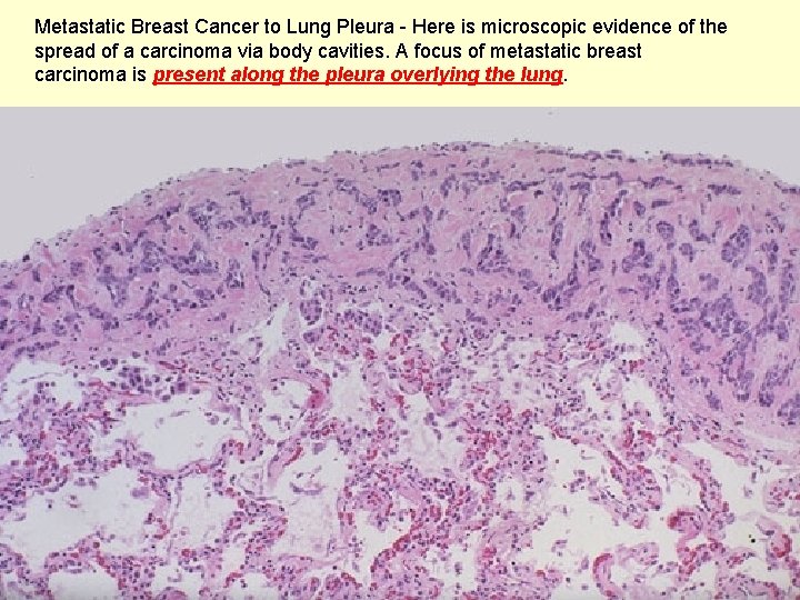 Metastatic Breast Cancer to Lung Pleura - Here is microscopic evidence of the spread