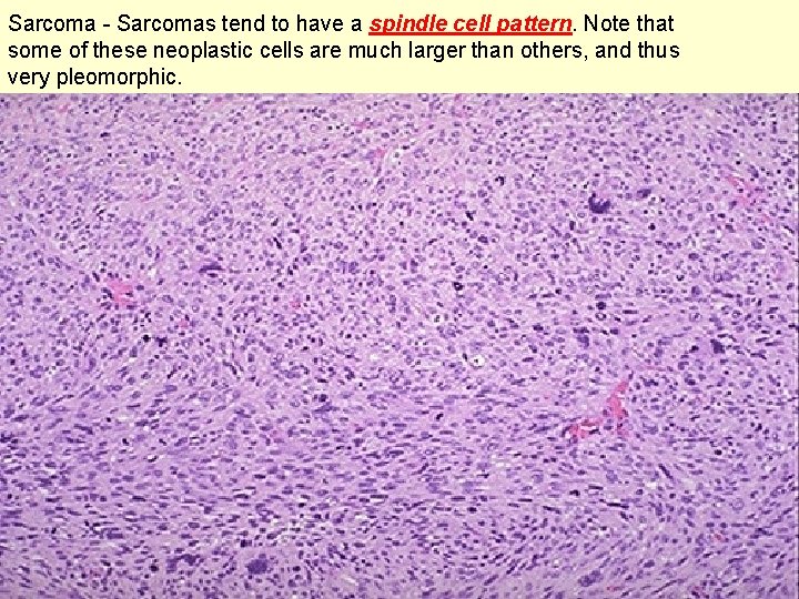 Sarcoma - Sarcomas tend to have a spindle cell pattern. Note that some of