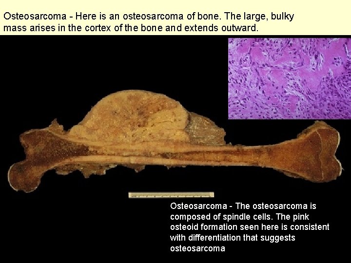 Osteosarcoma - Here is an osteosarcoma of bone. The large, bulky mass arises in