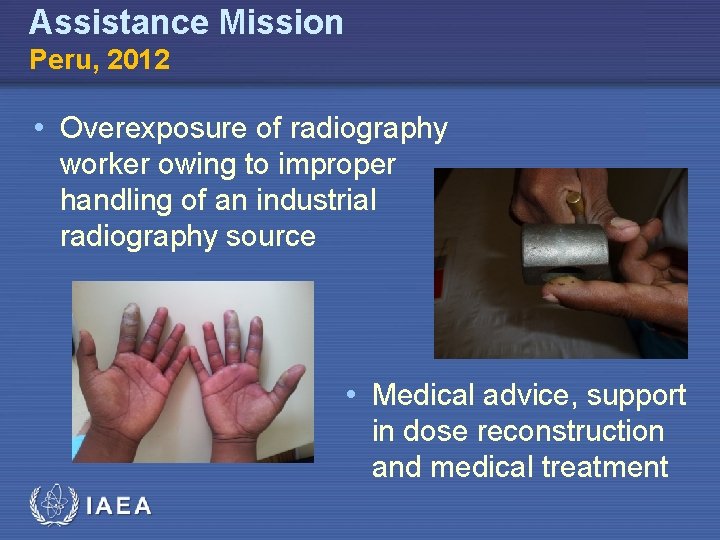 Assistance Mission Peru, 2012 • Overexposure of radiography worker owing to improper handling of