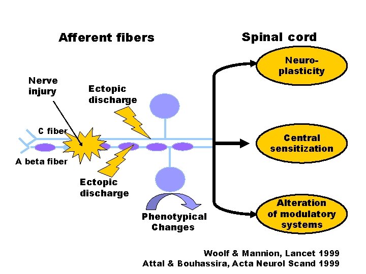 Afferent fibers Nerve injury Spinal cord Neuroplasticity Ectopic discharge C fiber Central sensitization A Afferent fibers Nerve injury Spinal cord Neuroplasticity Ectopic discharge C fiber Central sensitization A