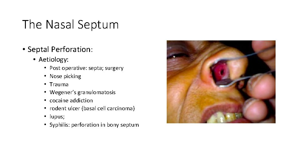 The Nasal Septum • Septal Perforation: • Aetiology: • • Post operative: septa; surgery