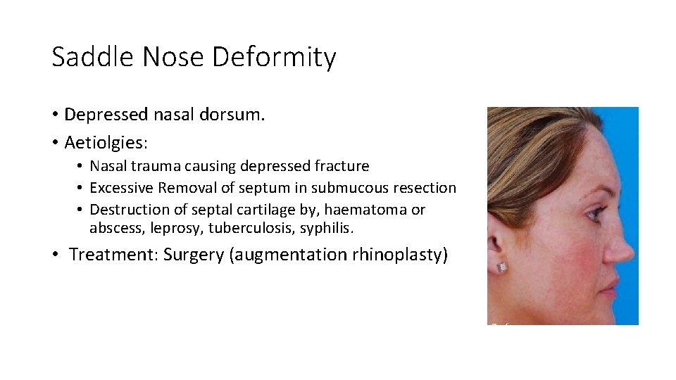 Saddle Nose Deformity • Depressed nasal dorsum. • Aetiolgies: • Nasal trauma causing depressed