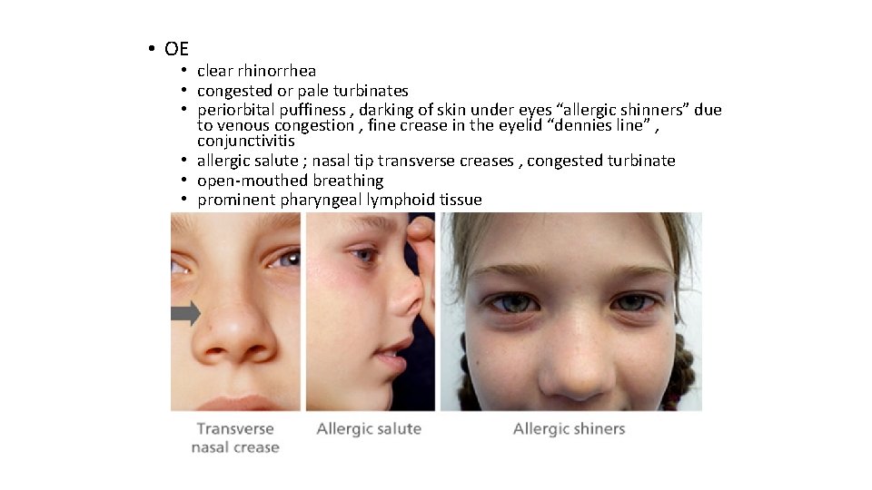  • OE • clear rhinorrhea • congested or pale turbinates • periorbital puffiness