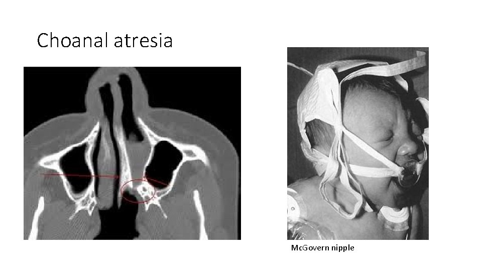 Choanal atresia Mc. Govern nipple 